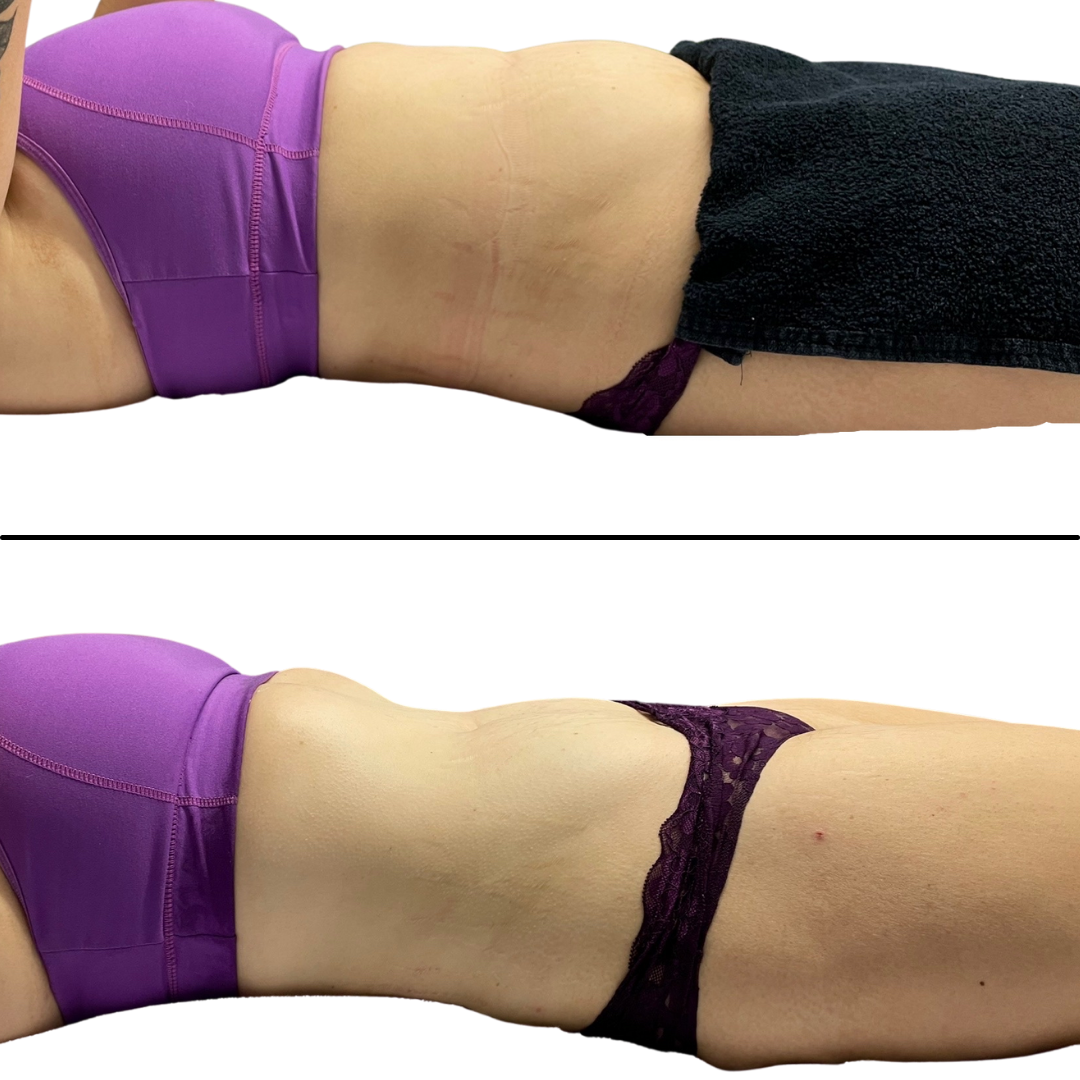 Non-Invasive Body Contouring Procedures to Get Holiday Ready
