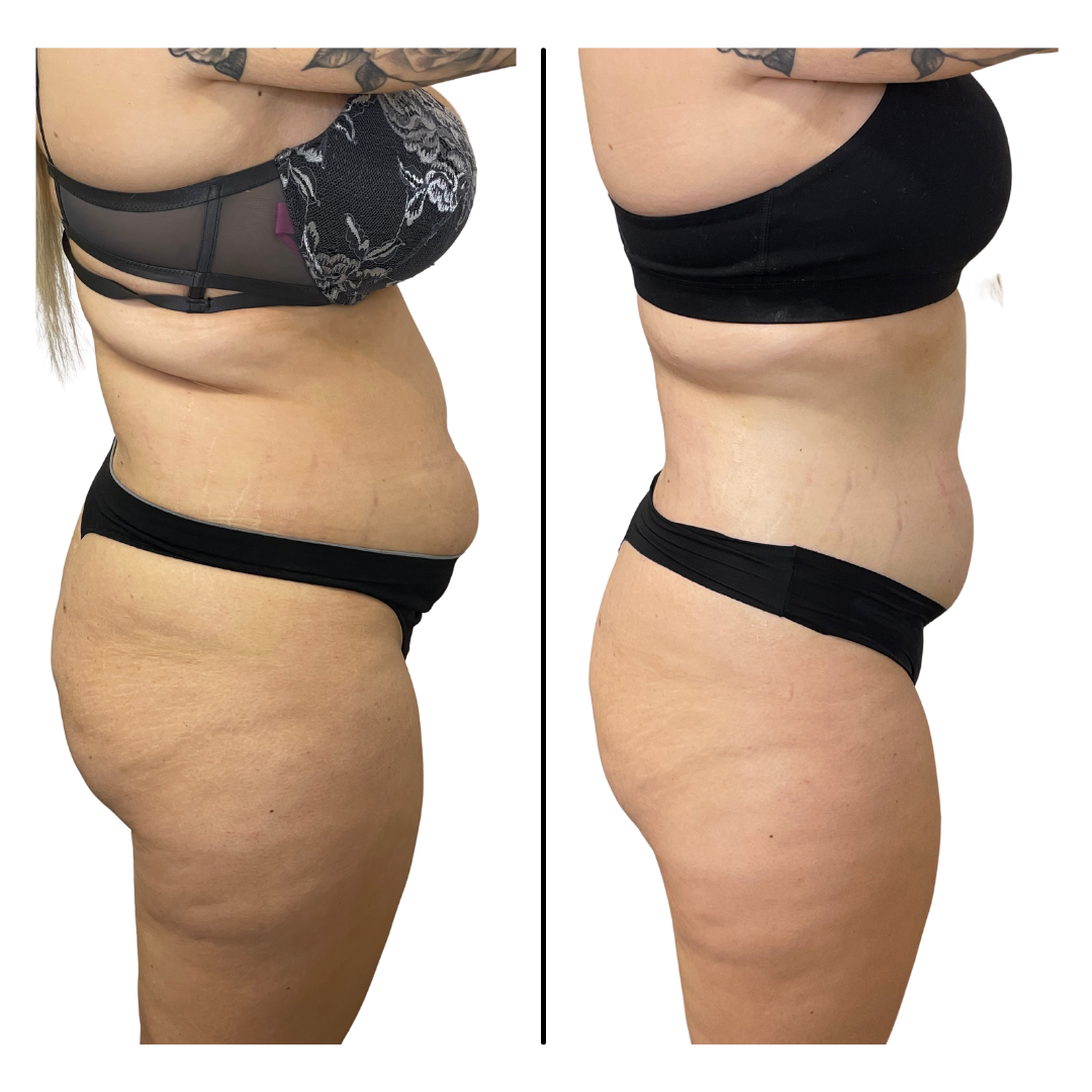 Non-Invasive Procedures for Body Shaping — The Glow Girl by
